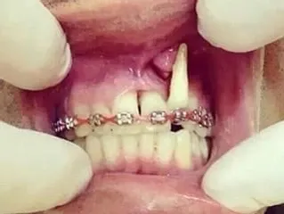 Ortodoncia correctiva para diente con 
                        raíz expuesta